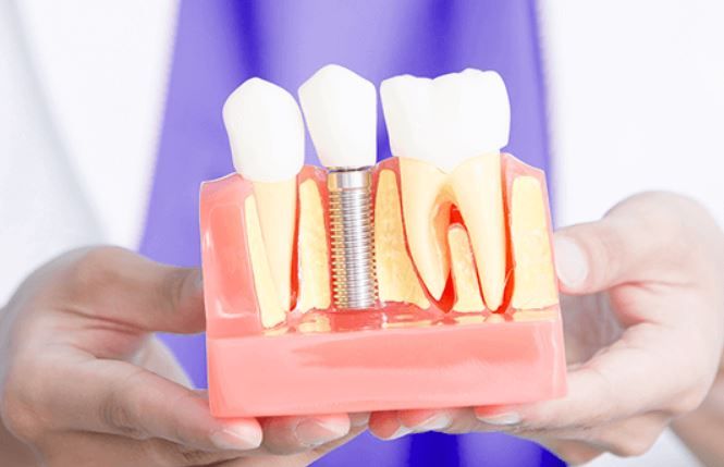 (P) Te poți bucura de beneficiile unui implant dentar indiferent de v&acirc;rstă! Iată detaliile