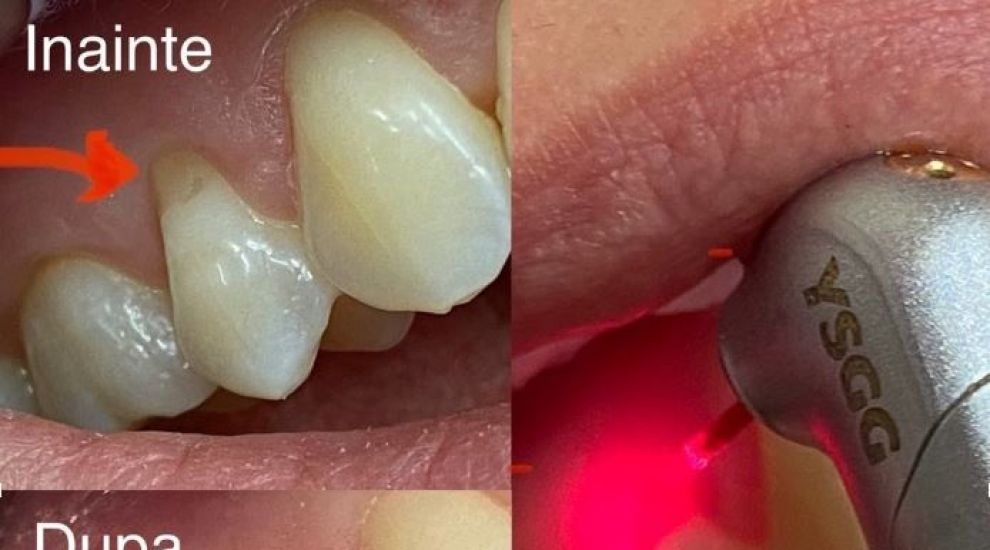 (P) Scapă de cariile dentare făra durere si fara anestezie!