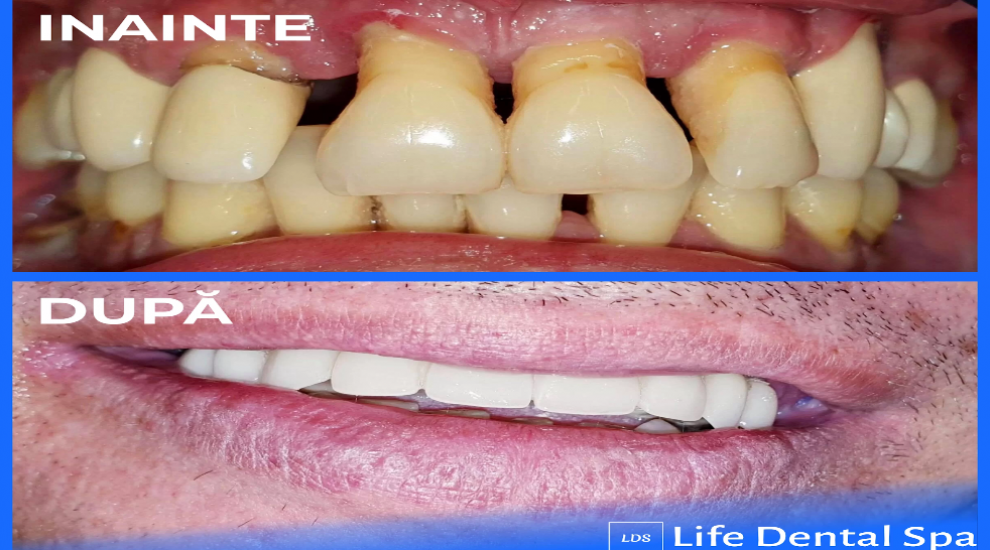 (P) Dinți ficși pe implanturi într-o singura zi, cu ajutorul laserului dentar (P) Dinți ficși pe implanturi într-o singura zi, cu ajutorul laserului dentar