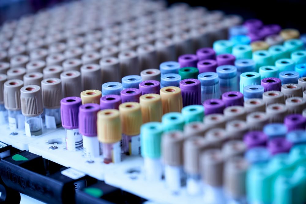Cercetătorii au dezvoltat un test de sânge care poate detecta boala Alzheimer