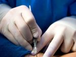 Bisturiul inteligent, care identifica tesutul canceros