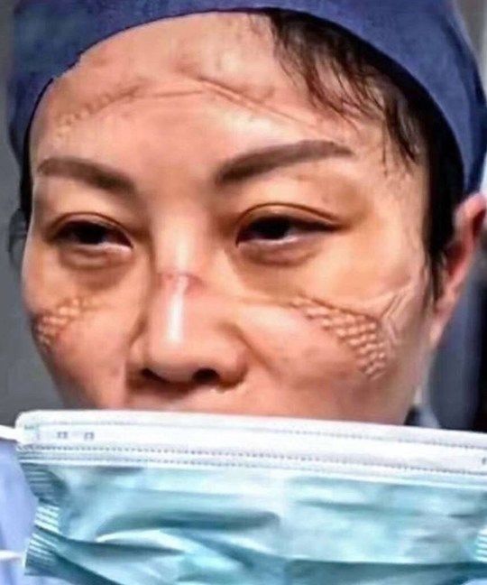 Imagini Socante Medicii Care Ii Trateaza Pe Chinezi De Coronavirus Desfigurati De La Echipamentul De Protectie Sunt Epuizati Sport Ro